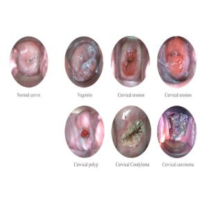 High Definition Echo - Digital Electronic Colposcope Gynaecologic Apparatus