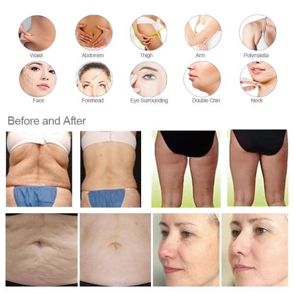 Professional Therma Sculpt Vela Shape Machine Rf Vacuum Cavitation Butt Lifting