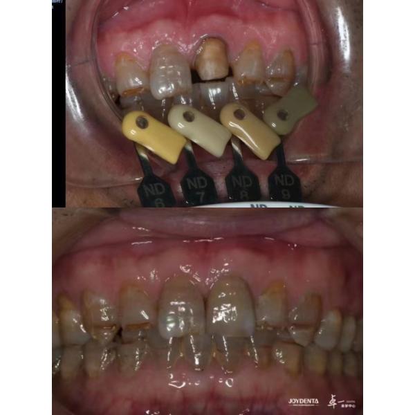 Translucency Zirconia Crowns Multilayered Gradient Technology For Optimal