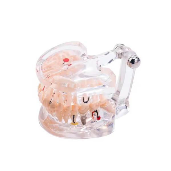 Buy 32 Tooth Full Month Implant Disease Teeth Model Clear Design  Dental Pathology Model at wholesale prices