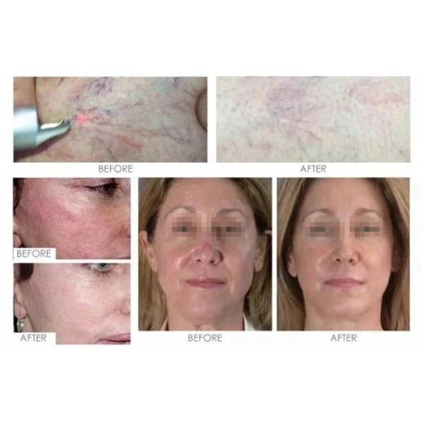 Portable Diode 980nm Laser Spider Vein Removal Machine / Vascular Laser Machine