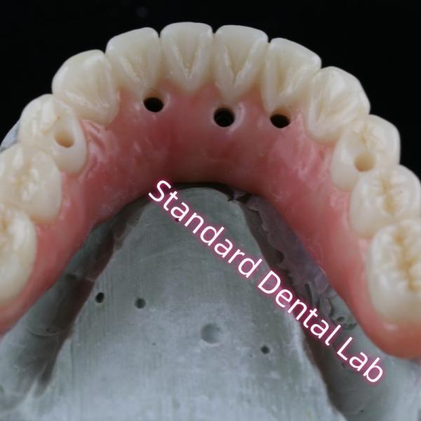 Dental Implant Crown PFZ Porcelain Layered Zirconia Screw Retained With Pink Gum