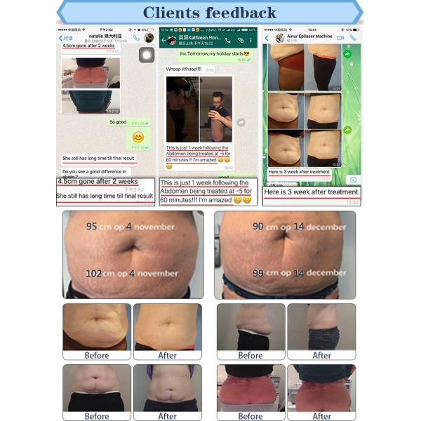 Coolsculption cryolipolysi fat freezing body slimming cryolipolysis weight loss