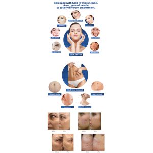 Morpheus 8 Microneedle RF Machine Wrinkle Removal ISO Certified