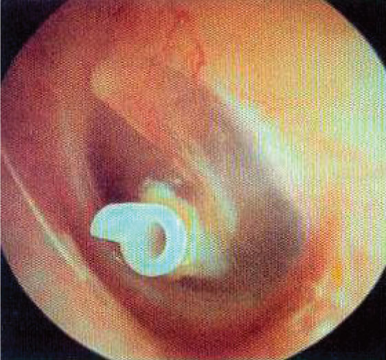 Advanced right ear inspection Clinical simulation for hospital training