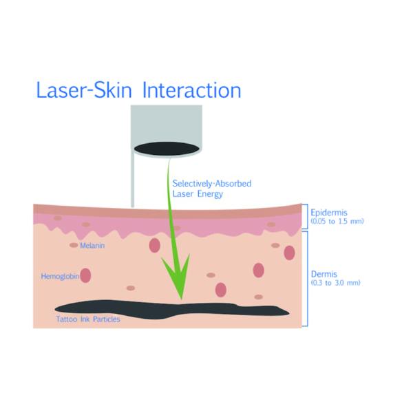ND YAG Q Switch Laser Tattoo Removal Machine Sun Spot Removal SFDA