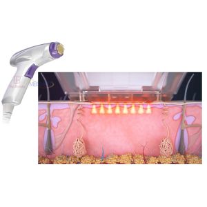 Rf Fractional Microneedle Rf Face Lifting Anti Wrinkle Machine