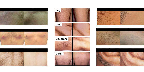 12*20 big spot 808nm portable diode laser hair removal/laser hair removal machine diode