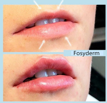 CE Certificate Hyaluronic Acid Cross Linked Dermal Filler For Fuller Lips