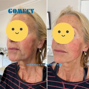 Endolift 980NM 1470NM Diode Lase Double Wavelength Professional Liposuctio