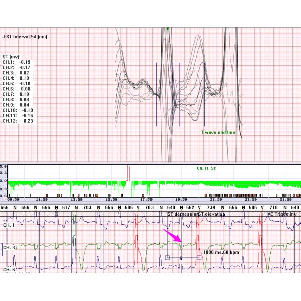 Portable ECG Machine Mini grabadora digital holter de ECG de 3 canales de 3 días con Detección de marcapasos