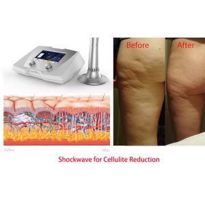 body slimming equipment Acoustic Wave therapy machine body reshaping body