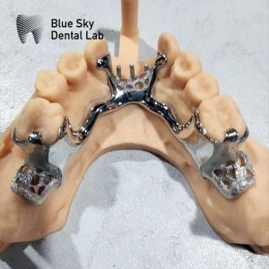 Skelete Chrome Metal Partial Denture Printed CoCr Denture Design
