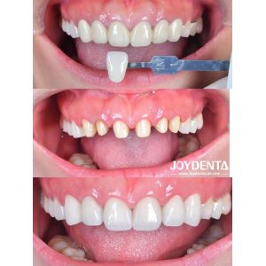 China Zirconia Dental Crown Case Study | Global Lab Outsourcing - Joydentalab on sale