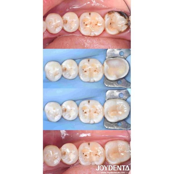 Customizable Dental Porcelain Inlay Restoration For Perfectly Fitted Teeth