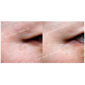 Polycaprolactone Hyaluronic Acid Serum Collagen Rejuvenation PCL Injection