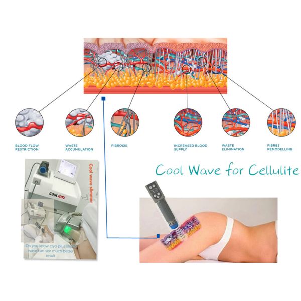 Mobile Cryolipolysis Fat Freezing Machine For Weight Loss Compact Size
