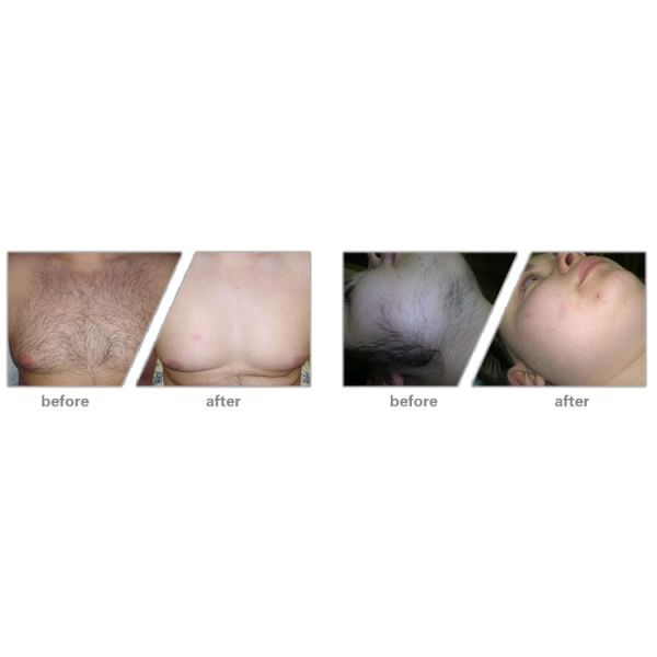 SHR E-Light Beauty Machine For Hair Removal / Skin Rejuvenation / Acne Treatment