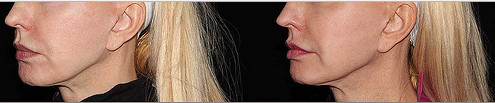 Fractional Co2 Laser For Acne Scars