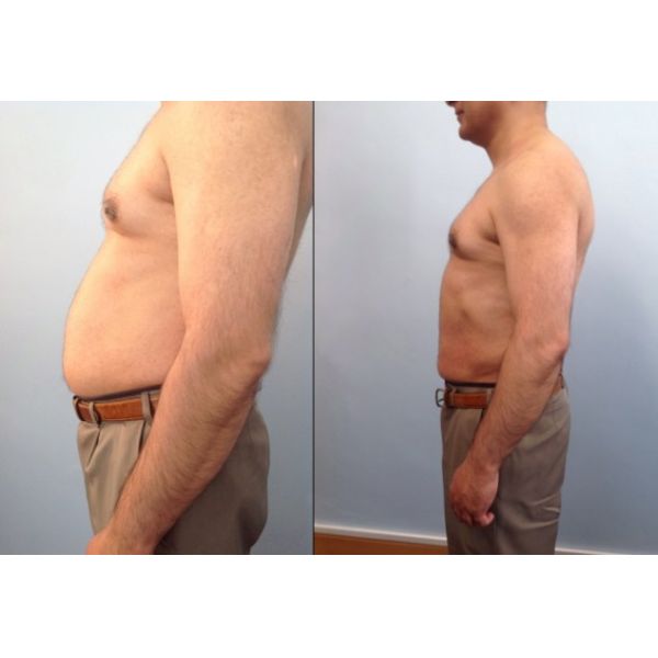 Ultrashape hifu body contour ultrashape liposonix hifu slimming machine liposonix