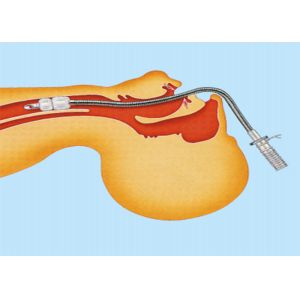 Medical Disposable Supplies Stainless Steel Laser Resistant Endotracheal Tube