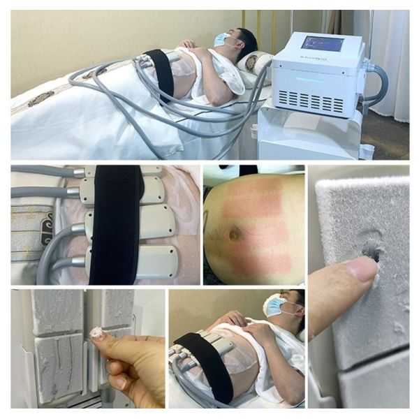 Ems Fat Reduce Cryo Plate Machine With 4 Cooling Pads