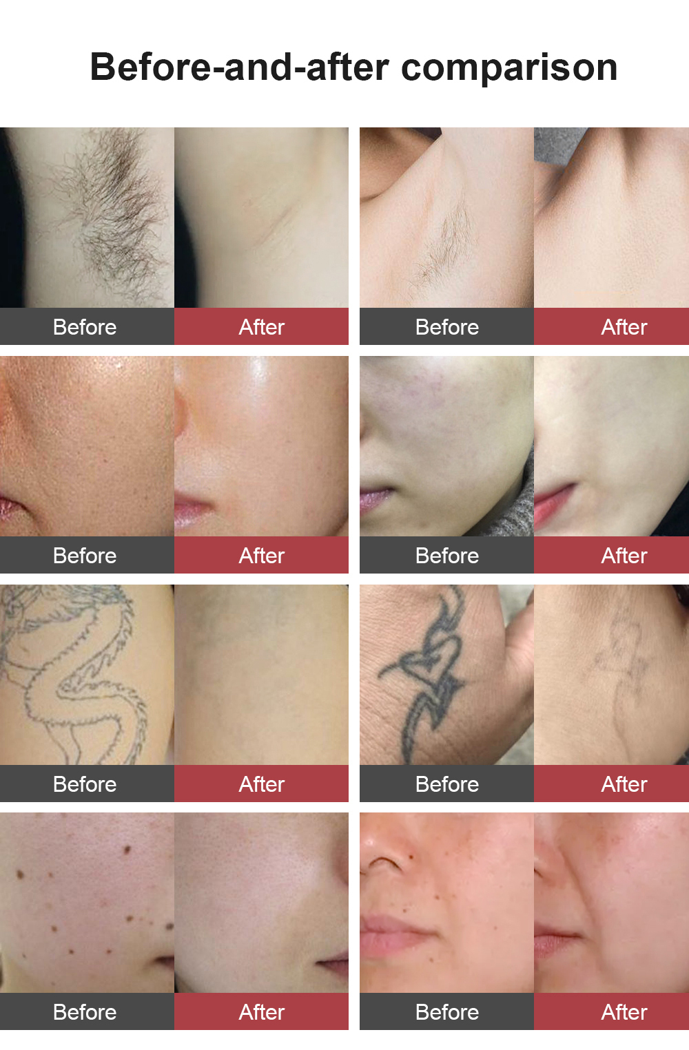 76 Kg Diode Laser Hair Removal Machine In Custom Colors For High Demand