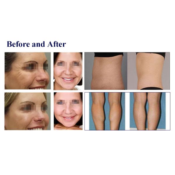 Ultrasound High Intensity Focused Ultrasound Machine 3D Anti Wrinkle Skin Tightening