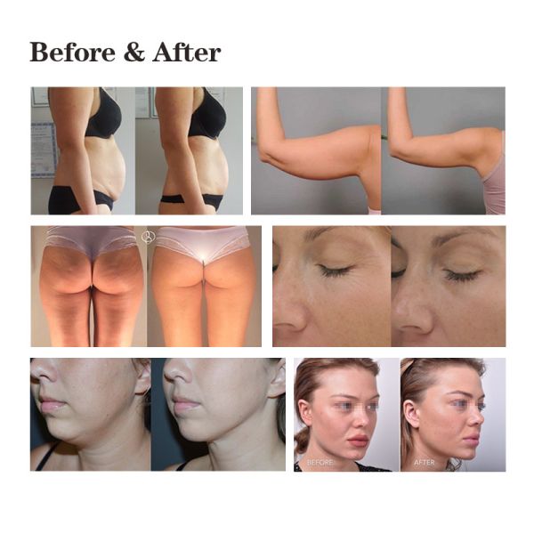 RF Body Slimming Vacuum Cavitation Body Shape Machine Weight Loss Fat Removal