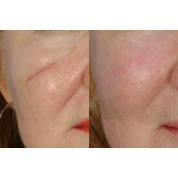 Safety CO2 Acne Scar Removal Machine , Carbon Dioxide Laser Resurfacing Machine