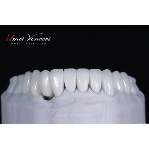 Transparent and smooth porcelain veneer