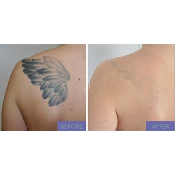 Stationary Laser Tattoo Removal System , Professional Tattoo Removal Machine