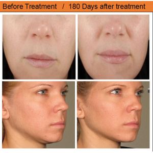 2 years warranty hifu hifu hifu wrinkle removal