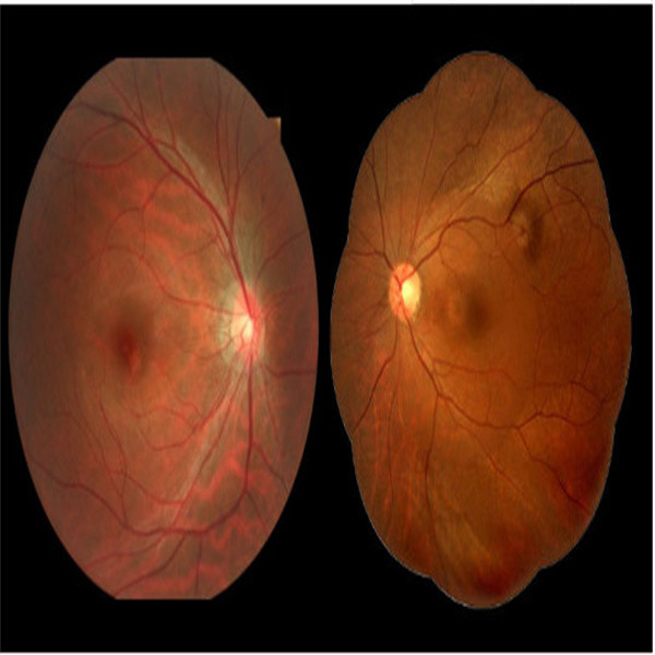 Non Mydriatic Digital Fundus Camera 5 Image Acquisition Modes Multifunctional