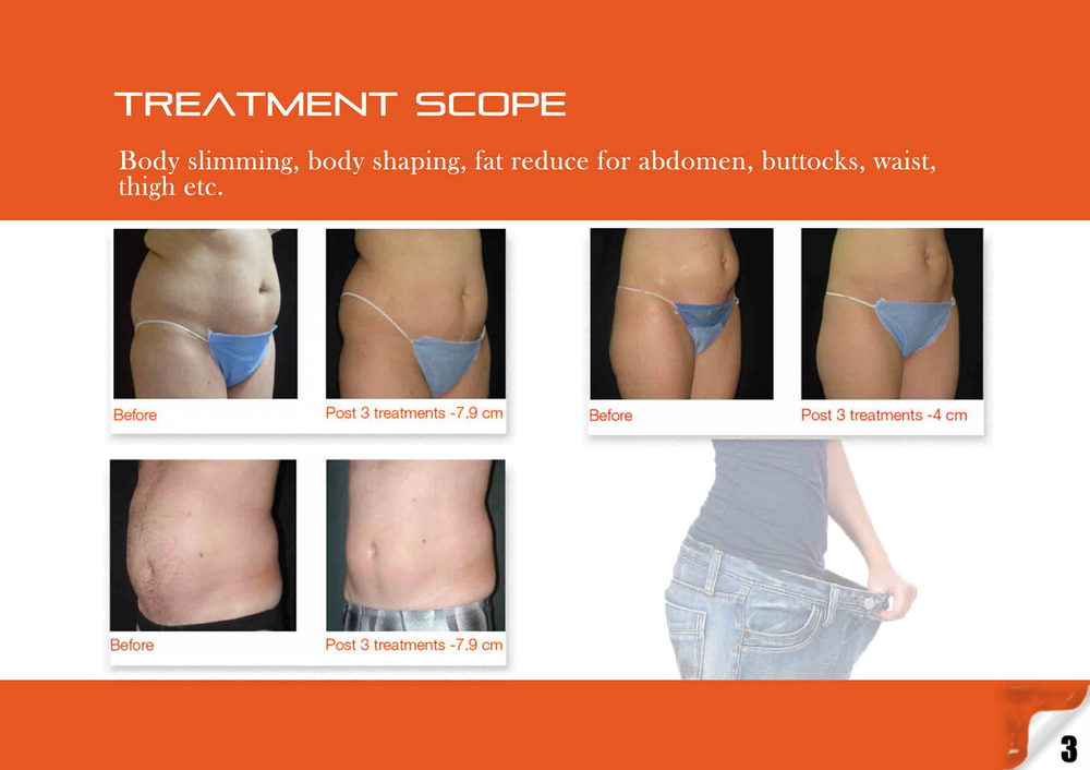 cryolipolysis simming machine coolsculpting