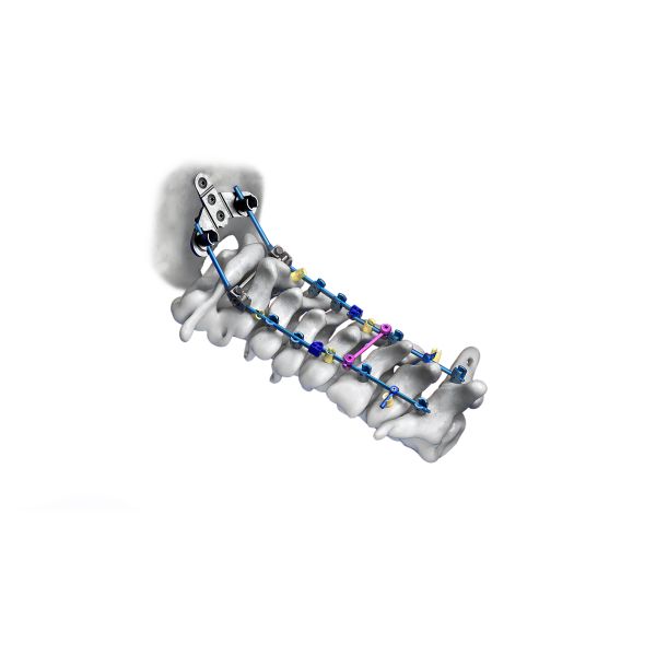 Buy 40mm - 100mm CrCoMo Pedicle Screw Cervical Spinal Fusion System at wholesale prices