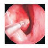 Sleeping Treatment Plasma Surgery System Probe For Nasal Capsule Surgery