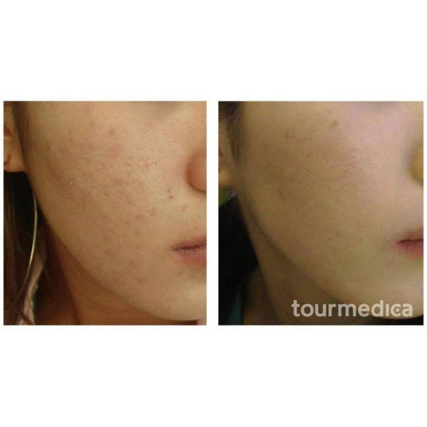 Pixel CO2 Vaginal Rejuvenation Machine , Laser Skin Treatment Equipment