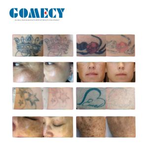 Gomecy Carbon Laser Peel Machine Whitening Face Ndyag Laser Machine