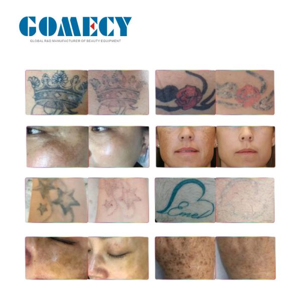 1064nm Wavelength Nd Yag Laser Machine Carbon Peel Laser Machine For Customer Requirements