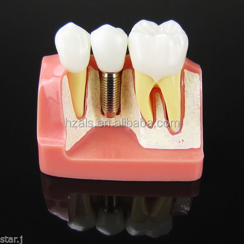 Class III Instrument Classification Dental Study Model for Dental Practice and Demonstration