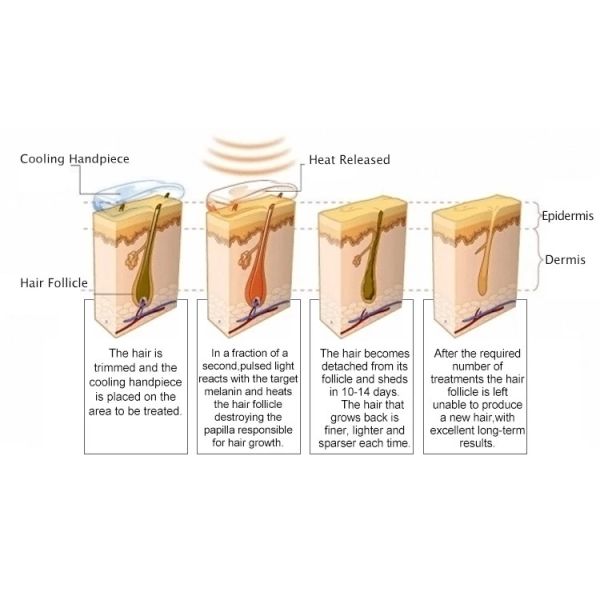 Wrinkle Remove E Light Laser Hair Removal Machine Fast Shots AFT SHR For Salon SPA