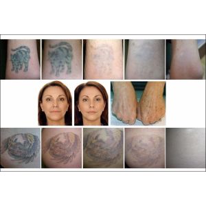 Picosecond Laser Tattoo Removal Machine Q Switch ND YAG Skin Rejuvenation