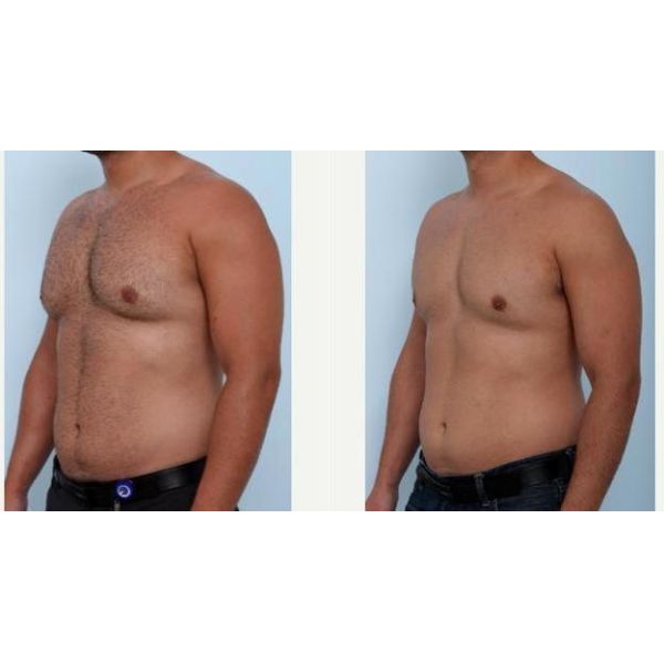 Dual Handles Fat Freeze Cryolipolysis Vacuum Slimming Machine