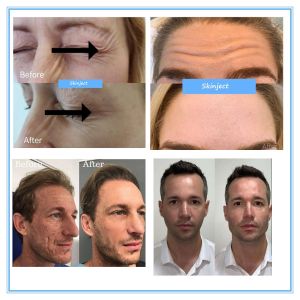 Hyamely Botax Wrinkle Removal Injection 100 Units Botulinum Toxin Beauty