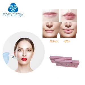China Fosyderm Hyafilia 2ml Lip Filler Hyaluronic Acid Gel Injection on sale