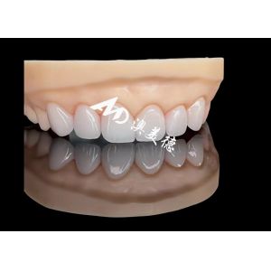 Porcelain EMAX Veneer High Precision Esthetic Restorations with Superior
