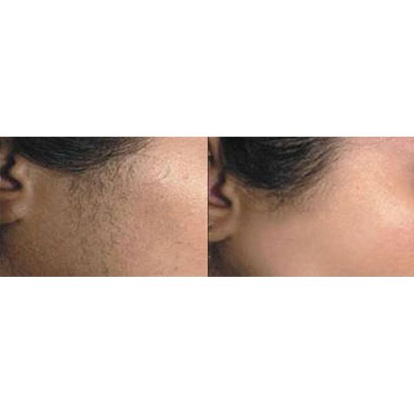 E - light IPL RF Permanent Elight IPL RF Skin Rejuvenation Hair Removal White Gray Machine with 250W