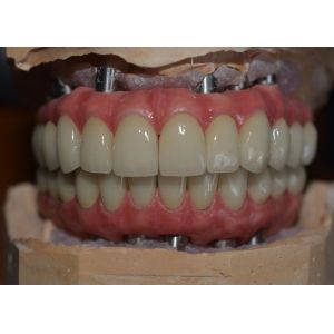 China Precision-Crafted Dental Implant Crowns for Comfort & Confidence on sale