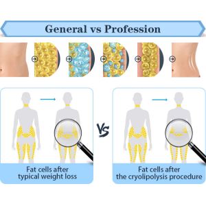 Multifunctional double chin removal weight loss cryo cool sculpting cavitation